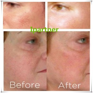 Ipartner LS980 Diode-laser letter rødmen